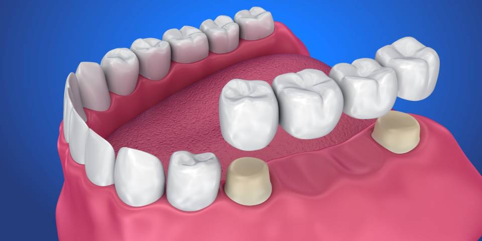 Best Dental Crowns, Bridges & Dentures Treatment in Wakad, PCMC | Dr. Ketaki Guddahe-Shinde