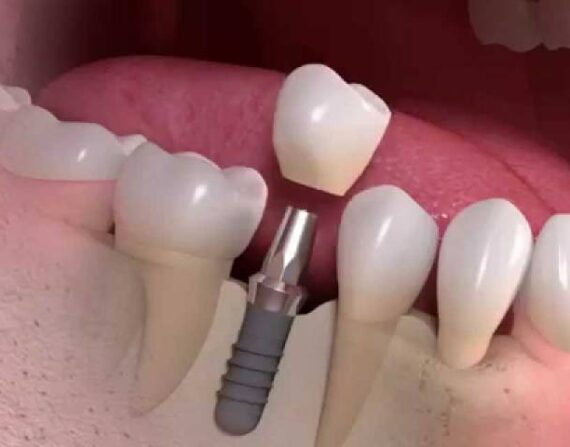 Best Dental implants Treatment in Wakad, PCMC | Dr. Ketaki Guddahe-Shinde