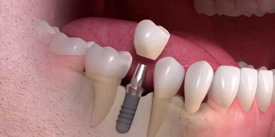 Best Dental implants Treatment in Wakad, PCMC | Dr. Ketaki Guddahe-Shinde