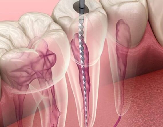 Root Canal Treatment Image