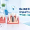Diagram comparing Dental Bridges vs. Implants for replacing missing teeth