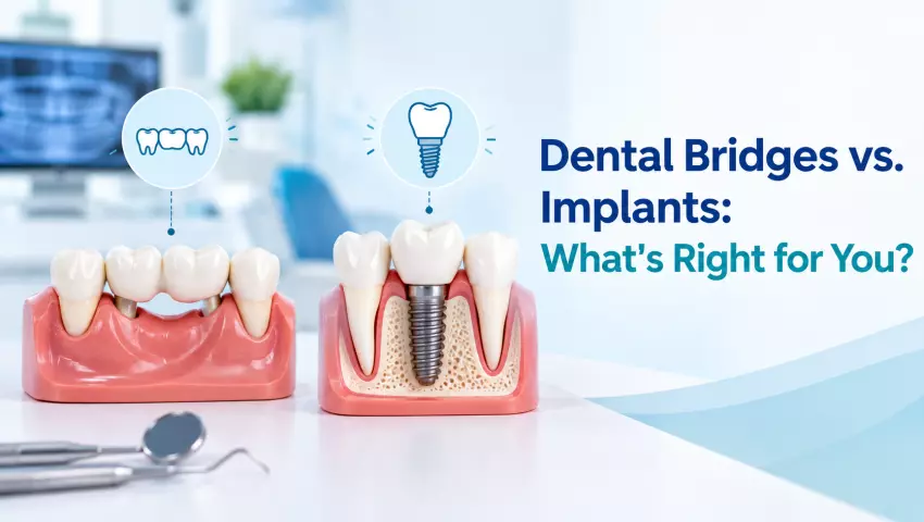 Diagram comparing Dental Bridges vs. Implants for replacing missing teeth